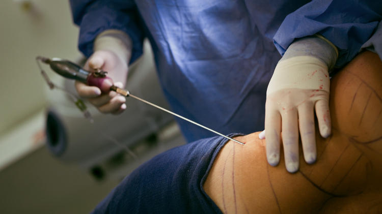 Liposuction