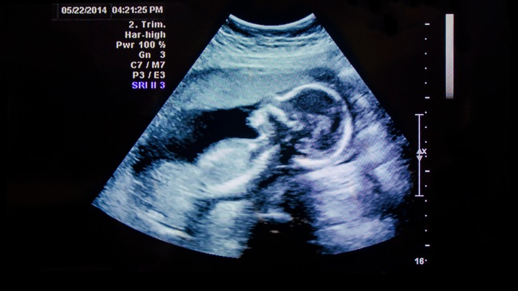 Ultrasound image